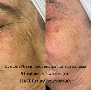 IPL for skin rejuvenation