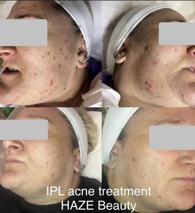 IPL treatment to treat acne