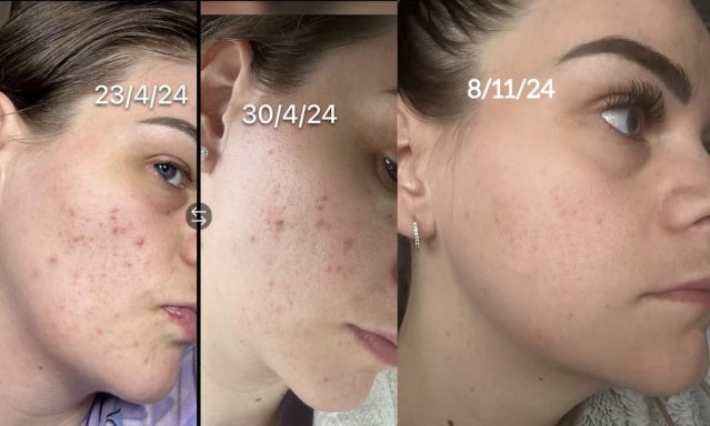 IPL for acne